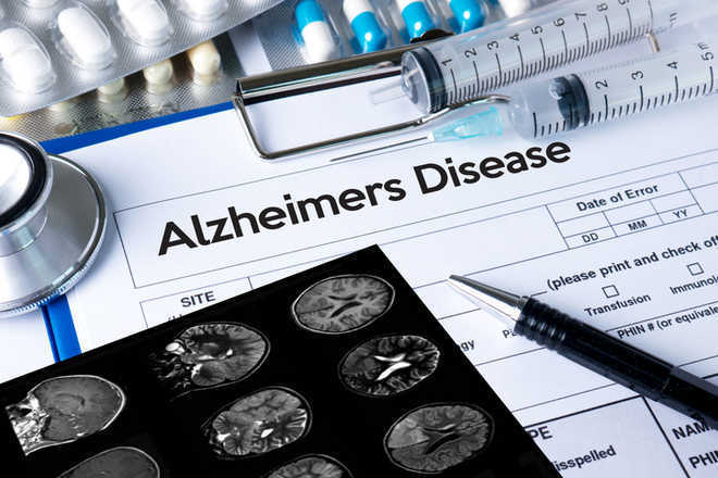Brain stimulation may help treat Alzheimer’s disease: Study