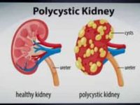 Polycystic Kidney Disease: Causes and Symptoms