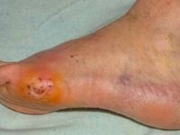 Diabetes: Early detection and management of diabetic foot complications