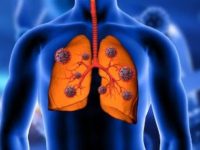 What are the types of lung cancer? Know symptoms, causes and treatments from expert