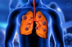What are the types of lung cancer? Know symptoms, causes and treatments from expert