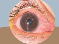 Iritis or inflammation of the iris: Causes, symptoms and care tips for your eyes