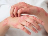 Leprosy-Free Future by 2027? Doctor explains how early diagnosis and treatment can help